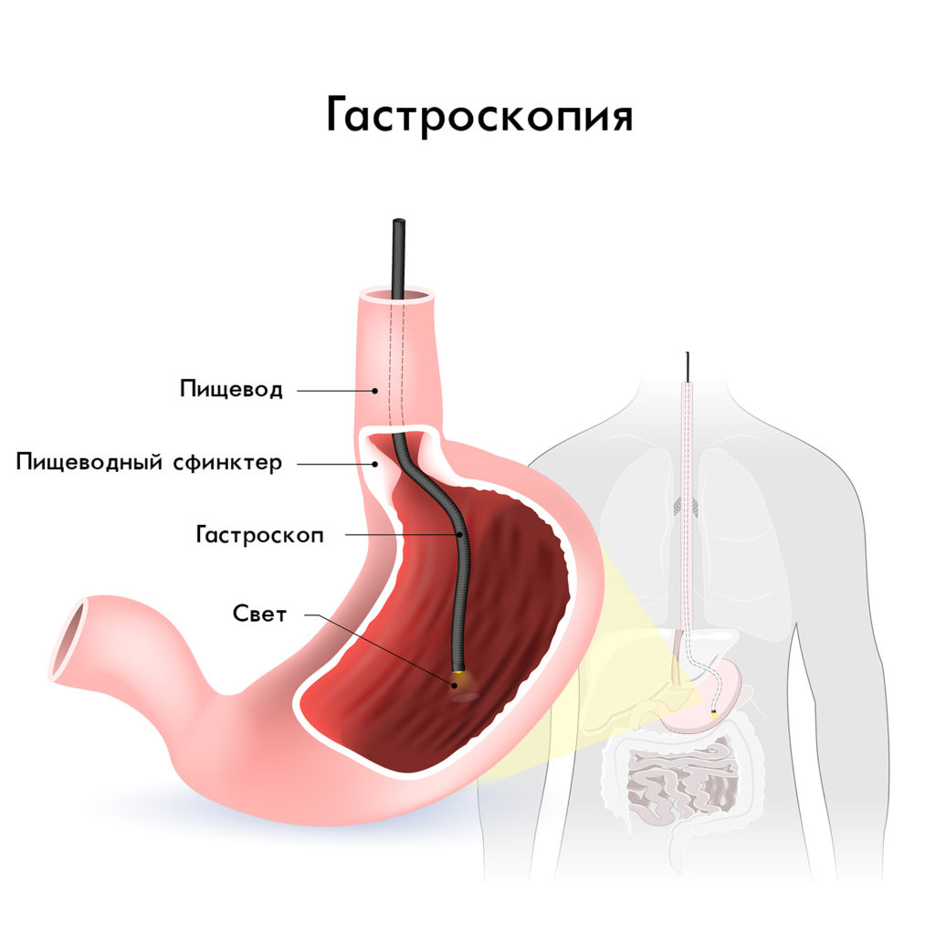 Эндоскопическое исследование желудка